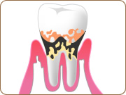 歯周病治療