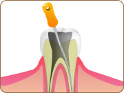 根管治療