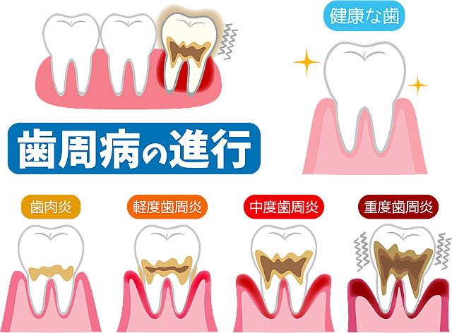 歯周病治療