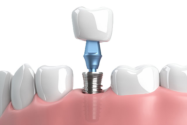 人工歯の成形・装着