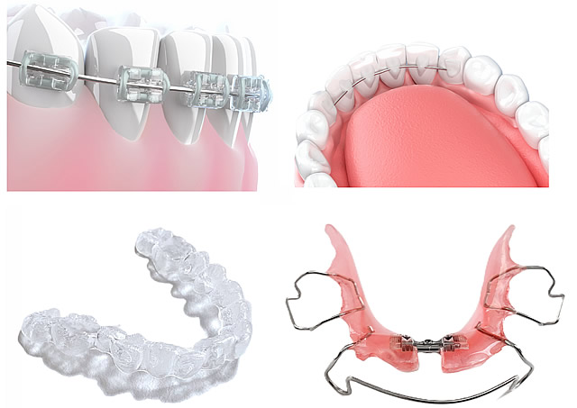 矯正治療の方法
