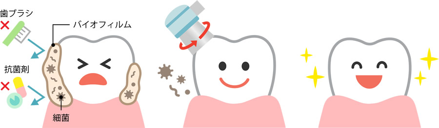 虫歯の予防