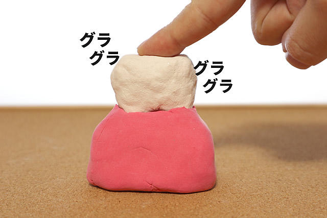 歯周病・歯肉炎の改善